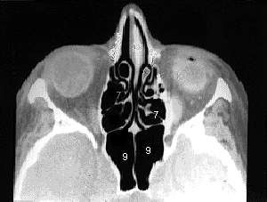 Esfemoidal e Trabeculado Etmoidal